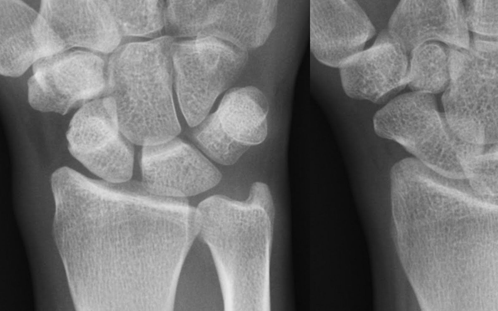 The best hand therapy treatment for De Quervain's disease