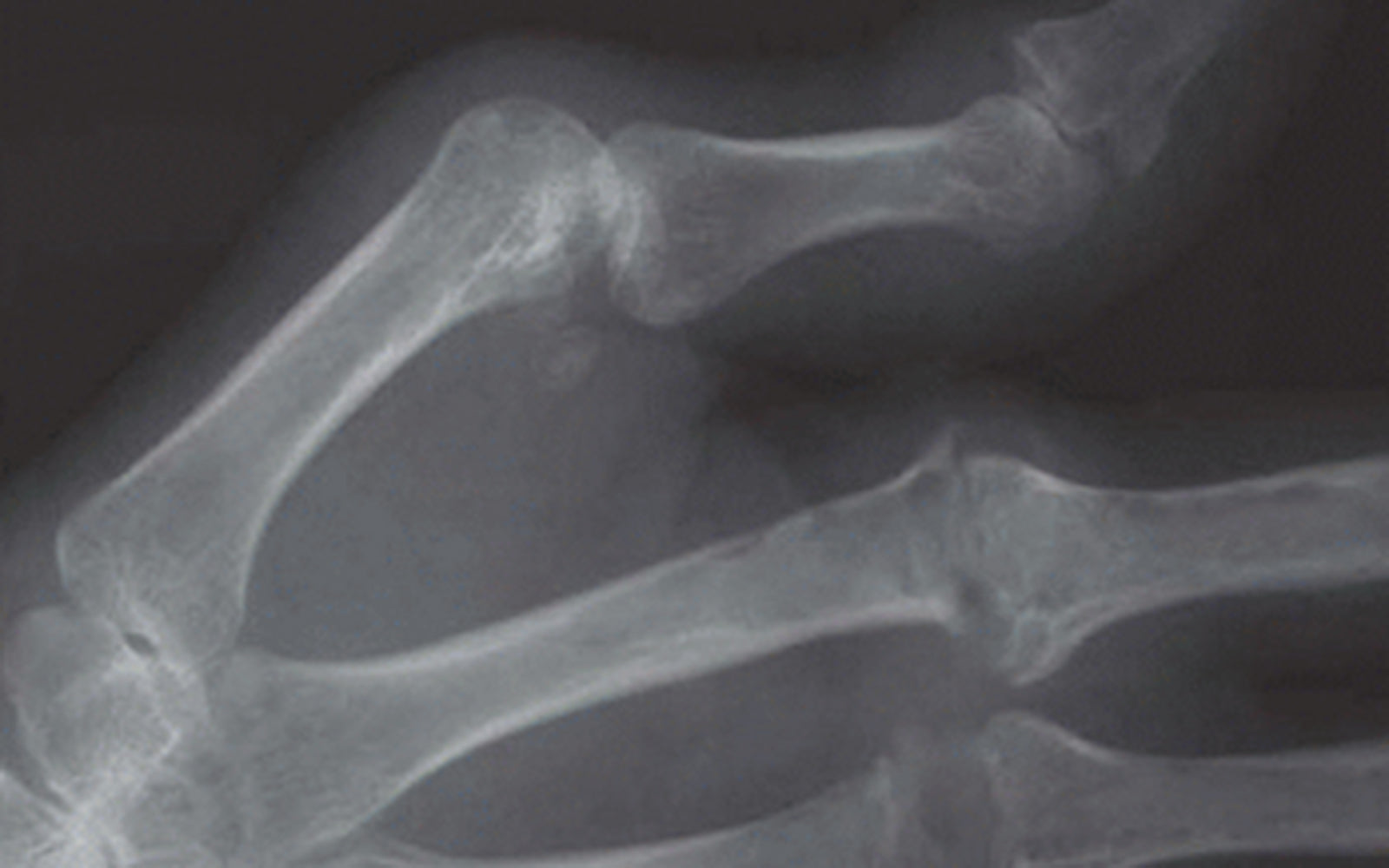 The best hand therapy treatment for Boutonnière deformity